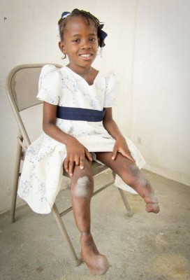 Schnailove, a Prosthetics Outreach Foundation beneficiary in Haiti. (Photo courtesy POF)