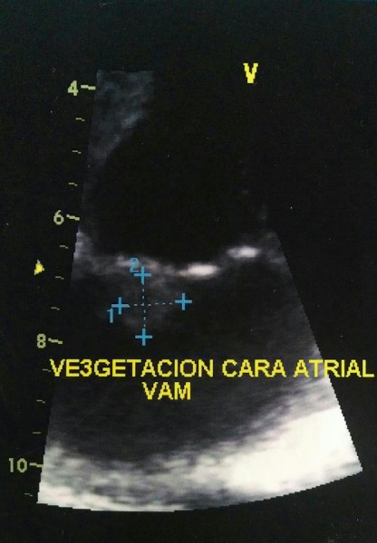 Echocardiogram results taken in Guanajuato showing vegetation on my heart valve.