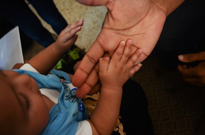 A volunteer doctor shows a birth defect on a refugee child's thumb, thought to be caused by exposure to chemical agents in explosives used in the civil war. (Photo by Alisa Reznick)